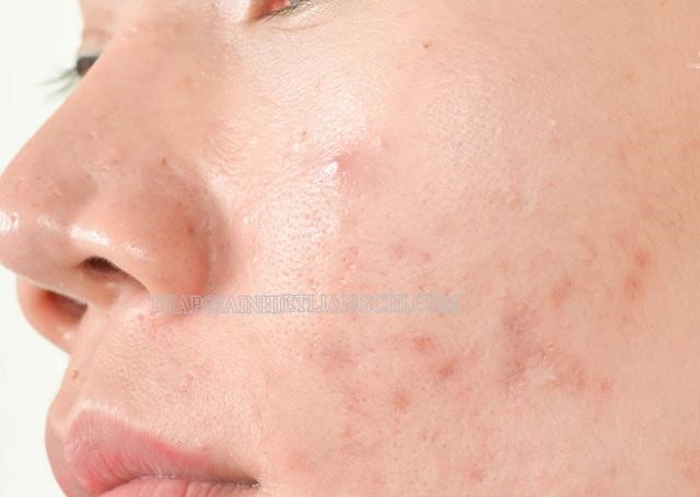 Da dầu thường xuyên bị nổi mụn ở nhiều vùng trên khuôn mặt