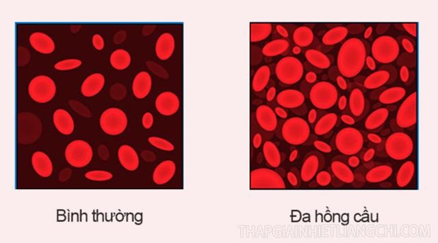 Huyết sắc tố cao có thể là dấu hiệu của bệnh đa hồng cầu