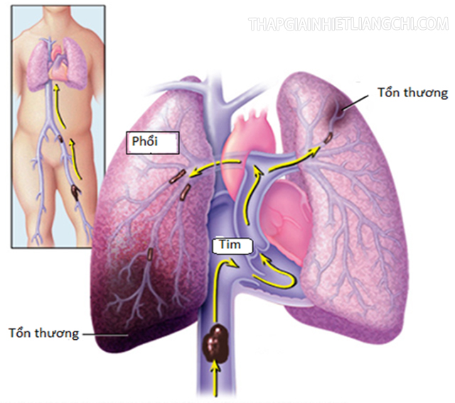 Đông máu ở phổi là lý do dẫn đến tình trạng thuyên tắc phổi