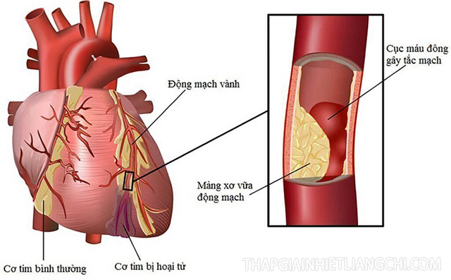 Đông máu ở tim có thể gây ra hoại tử cơ tim