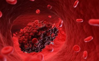 Cục máu đông không ở vị trí cố định mà theo mạch máu di chuyển khắp cơ thể