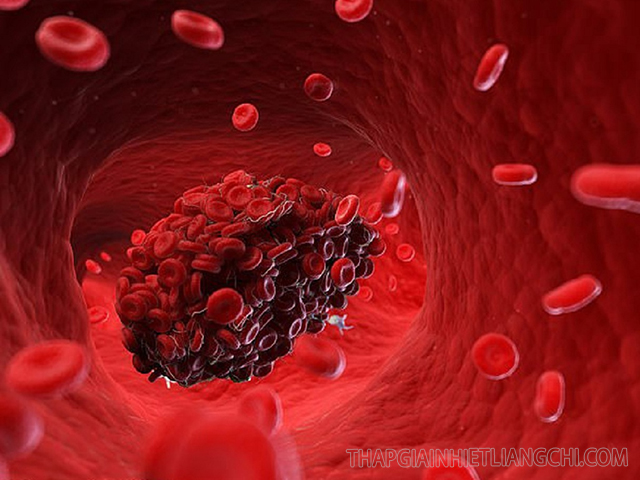 Cục máu đông không ở vị trí cố định mà theo mạch máu di chuyển khắp cơ thể